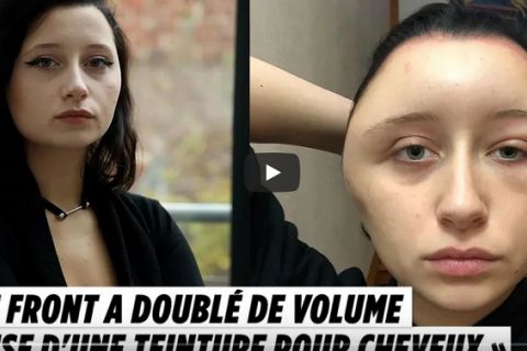 Ofabala kosu, pa zamalo umrla: Od alergijske reakcije glava je počela da joj se DEFORMIŠE - "Ne želim da se ovo dogodi nikom" (VIDEO)